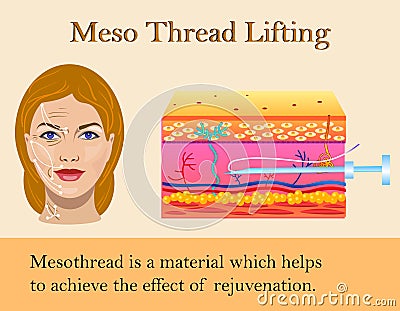 Vector illustration of meso threads lifting isolated Vector Illustration