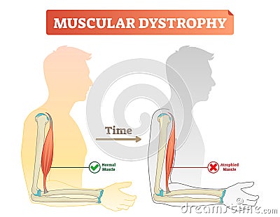 Vector illustration about muscular dystrophy. Compared normal muscle and atrophied muscle. Scheme with healthy and weak human. Vector Illustration