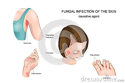 Nail,skin and hair fungus Vector Illustration