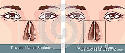 Vector illustration of a Nasal Septum Deviation Treatmen Vector Illustration