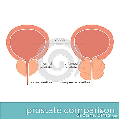 Vector illustration of normal and enlarged prostate Vector Illustration