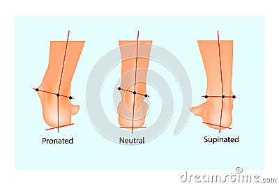 Vector illustration of the normal human foot and the foot with pronation and supination. Vector Illustration