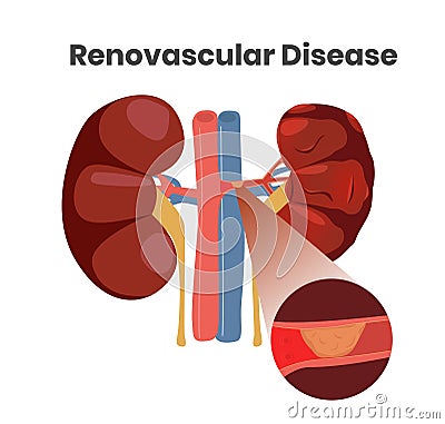 Vector illustration of the renovascular disease. Illustration of the thrombus in the artery of the kidneys Vector Illustration