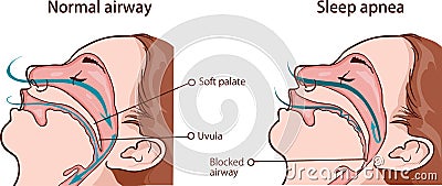 VECTOR ILLUSTRATION OF A SLEEP APNEA SYNDROME Vector Illustration