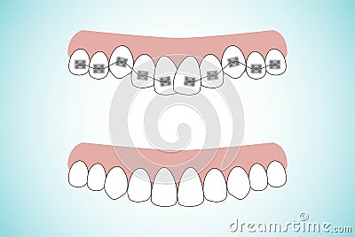 Vector illustration of the stages of orthodontic treatment braces on teeth . Teeth before and after braces on . Background in flat Vector Illustration