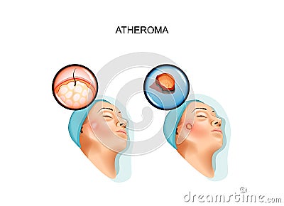 Surgery of benign tumors of atheroma Cartoon Illustration