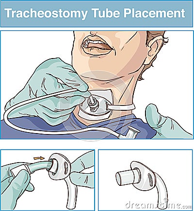 vector illustration of a tracheostomy tube placement Vector Illustration