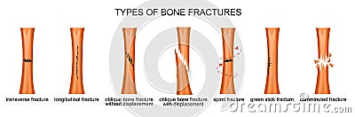 Types of bone fractures Vector Illustration