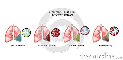 Types of exudative pleurisy and hydrothorax Vector Illustration