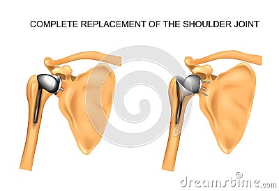 The types of prosthesis of shoulder Vector Illustration