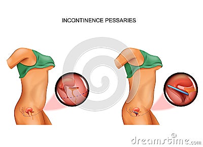 Use of pessary for incontinence Vector Illustration
