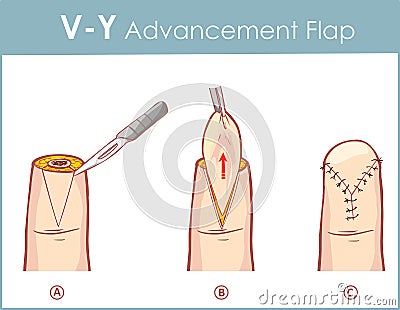 Vector illustration of a V-Y advancement flap Vector Illustration