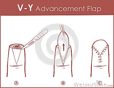 Vector illustration of a V-Y advancement flap Vector Illustration