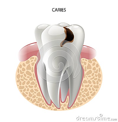 Vector image tooth caries disease Vector Illustration