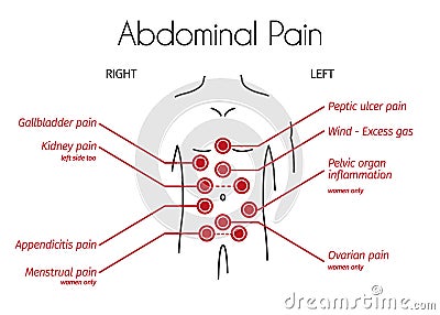 Vector Infographic of Abdominal Pain Types Vector Illustration
