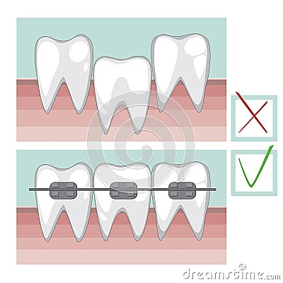 Vector teeth with braces on a healthy gum, a healthy bite concept with molars for orthodontist Vector Illustration