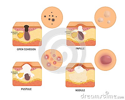 Vector types of acne Vector Illustration