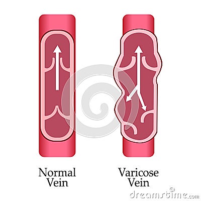 Vector varicose vein and normal vein. Varicose vein. Stock Photo