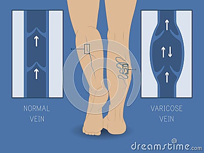 Vector varicose vein and normal vein. Slender and beautiful female legs. Vector Illustration