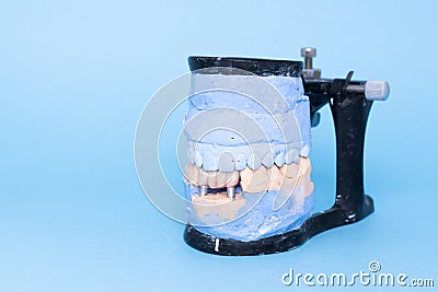 Veneers and crowns on gypsum dental artificial jaw on blue background. Upper and lower jaws plaster model with prepared Stock Photo