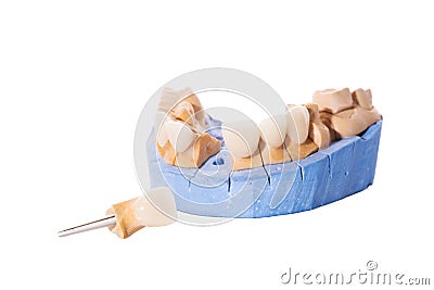 Veneers and crowns isolated on white background. Plaster model of teeth. lower jaw plaster model with prepared teeth Stock Photo