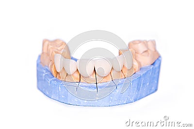 Veneers and crowns isolated on white background. Plaster model of teeth. lower jaw plaster model with prepared teeth Stock Photo