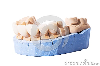 Veneers and crowns isolated on white background. Plaster model of teeth. lower jaw plaster model with prepared teeth Stock Photo