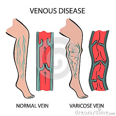 VENOUS DISEASE Varicose Veins Of Human Medicine Education Stock Photo