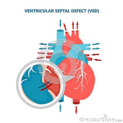 Ventricular septal defect VSD with heart blood flow. Human heart muscle diseases cross-section. Vector Illustration
