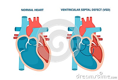 Ventricular septal defect VSD. Human heart muscle diseases cross-section. Cardiology concept. Vector Illustration
