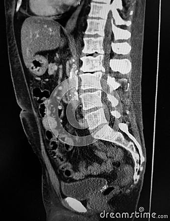 Vertebral degenerative joint disease with spondylosis, foraminal stenosis Stock Photo