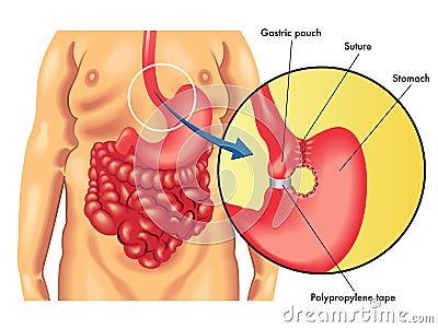 Vertical banded gastroplasty Vector Illustration