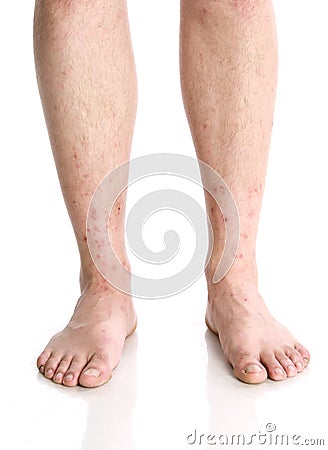 Vertical closeup shot of male feet with red rashes Stock Photo