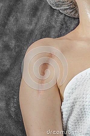 Vertical keloid scar after bone surgery on a womanâ€™s shoulder Stock Photo