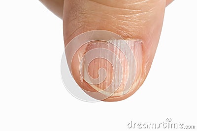 Vertical ridges on the fingernails Stock Photo