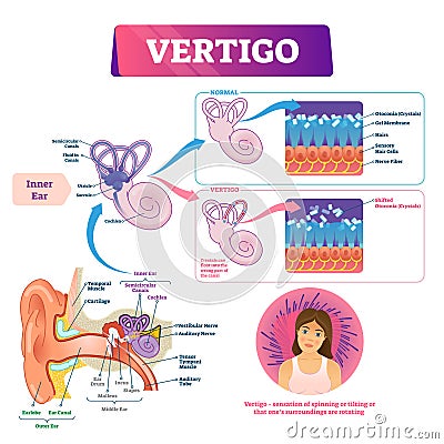 Vertigo vector illustration. Labeled medical vestibular ear problem scheme. Vector Illustration