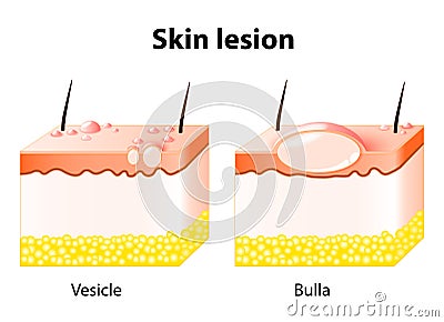 Vesicle and Bulla. Skin lesion Vector Illustration