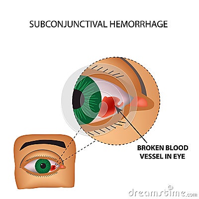 The vessel in the eye burst. Inflammation and redness. The structure of the eye. Infographics. Vector illustration Vector Illustration