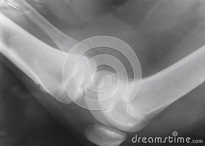 View of human knee joint on X-ray image Stock Photo