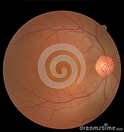 View inside human eye showing retina, optic nerve and macula. Health concept Stock Photo