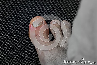 View of a toe with an inflamed nail bed panaritium/ paronychia Stock Photo