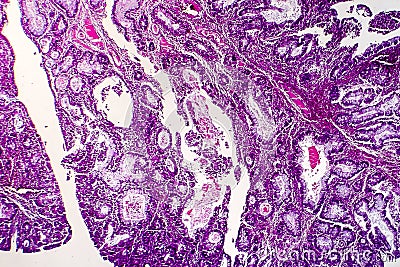 Villous colon adenocarcinoma, light micrograph Stock Photo