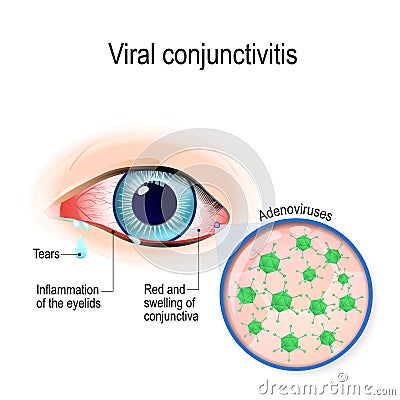 Viral conjunctivitis Vector Illustration