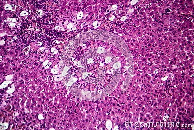 Viral hepatitis, light micrograph Stock Photo