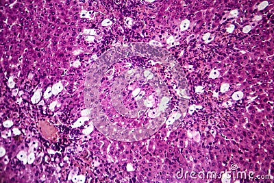 Viral hepatitis, light micrograph Stock Photo