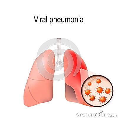 Viral pneumonia. Normal and inflammatory condition Vector Illustration