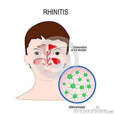 Viral sinusitis Rhinitis caused by adenovirus Vector Illustration