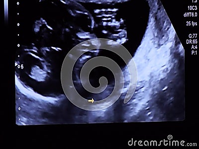 Visage De Foetus De Bebe De Semaines Regardant Directement L Ecran Pendant L Echographie Banque De Videos Video Du Fuselage Foetus
