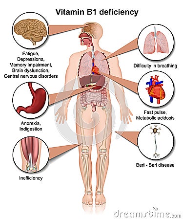 Vitamin B1 deficiency 3d medical vector illustration infographic on white background thiamine Vector Illustration