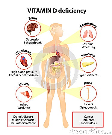 Vitamin D deficiency. symptoms and diseases Vector Illustration